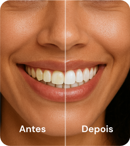 Fitas Clareadoras Dentais